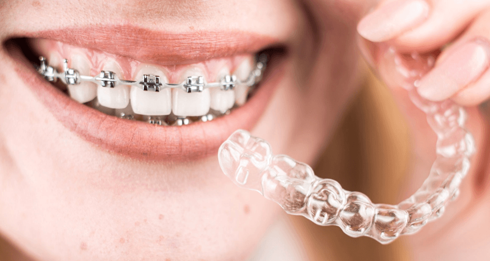 Hybrid orthodontic treatment - braces and Invisalign