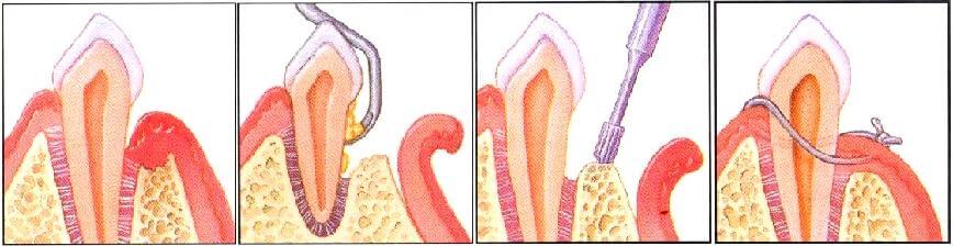 Flap Surgery Central London