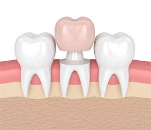 Porcelain Crowns