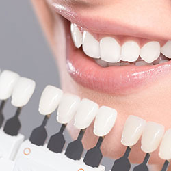 Dental Veneers Riverpark Dental