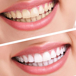 Teeth Whitening Riverpark Dental